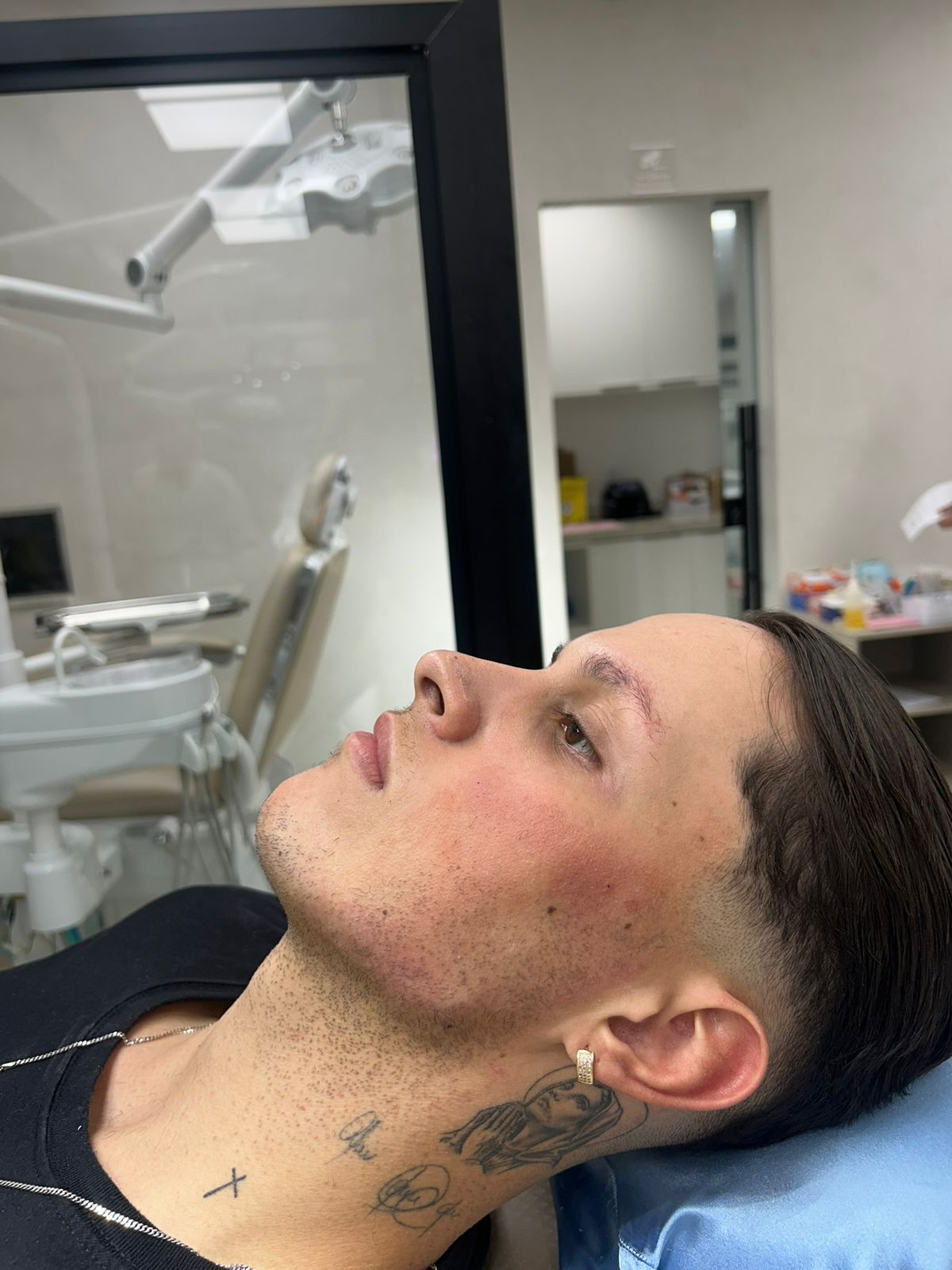 Depois — resultado de harmonização masculina com contorno mandibular